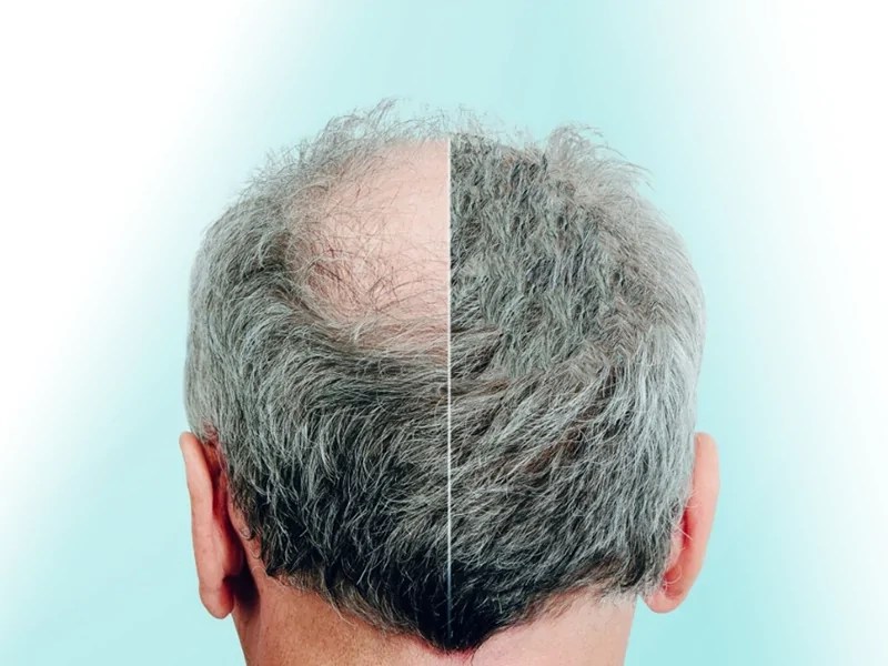 United Hair Clinic