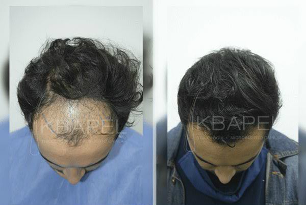 Kbapel Microinjerto Capilar | Expertos en Microinjerto Capilar en México clinic