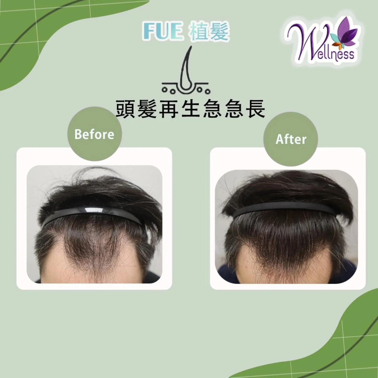 Before and after hair transplant result at WELLNESS Hair Transplant