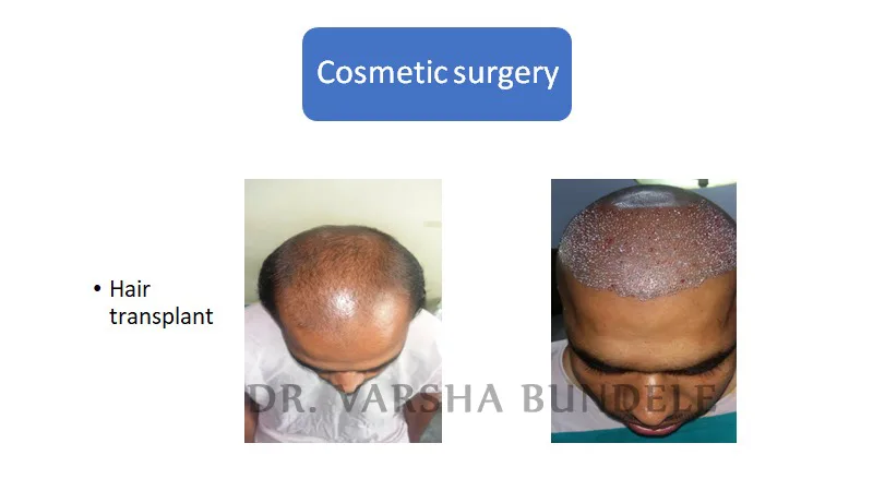 Before and after hair transplant result at TouchUp