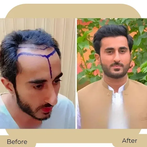 Before and after hair transplant result at Dynamic Aesthetic