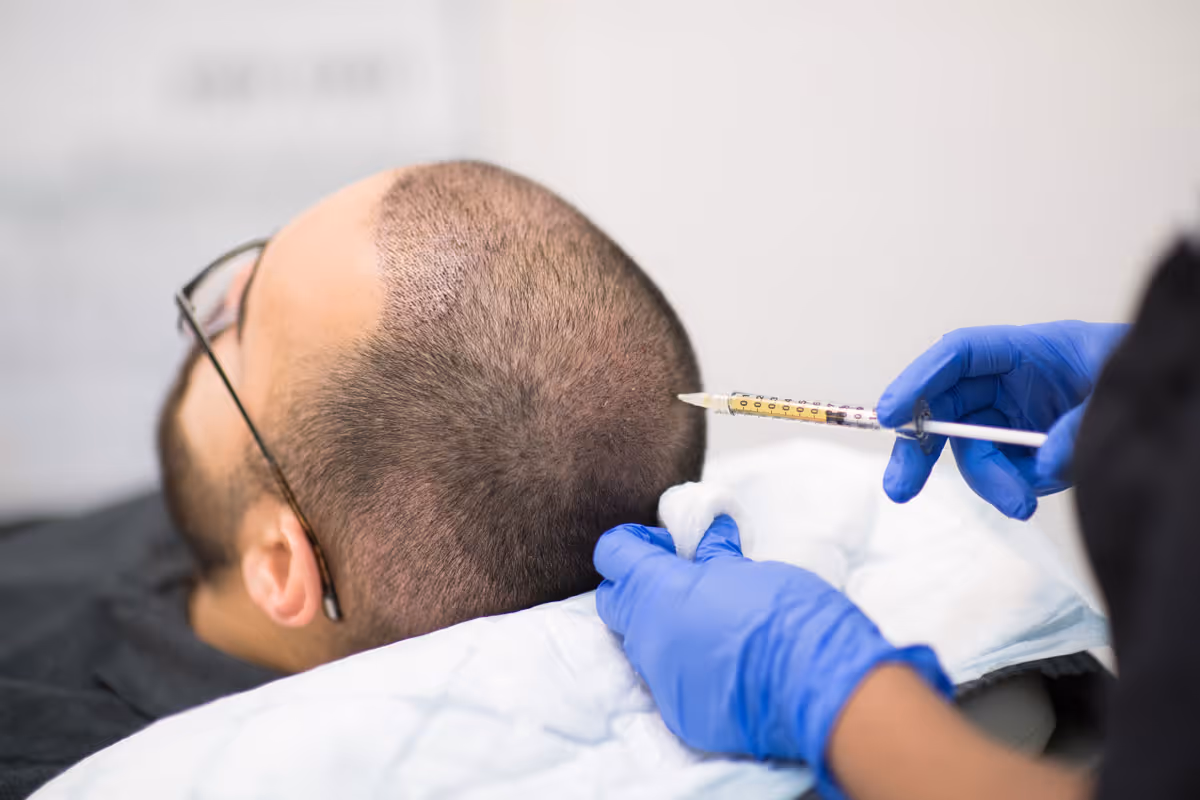 Finishing with PRP - Hair Transplant Surgeon at Nordic Hair Clinic — The Nordic region’s leading hair clinic