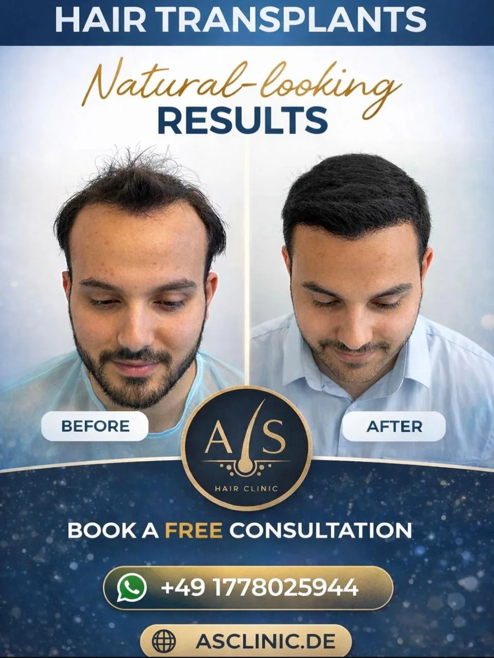 Before and after hair transplant result at asclinic
