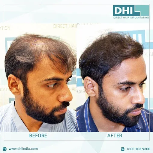 Before and after hair transplant result at DHI®