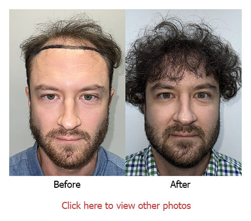29 years Experience in Hair Transplant and Hair Restoration
