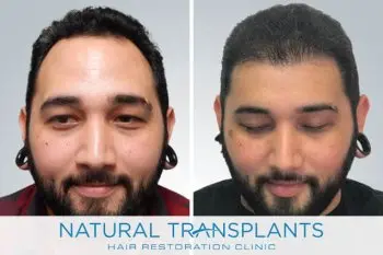 Kevin Blumenthal - Hair Transplant Surgeon at Natural Transplants
