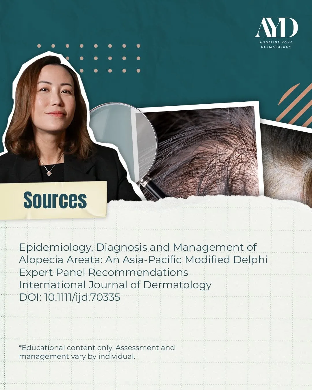 Before and after hair transplant result at Angeline Yong Dermatology