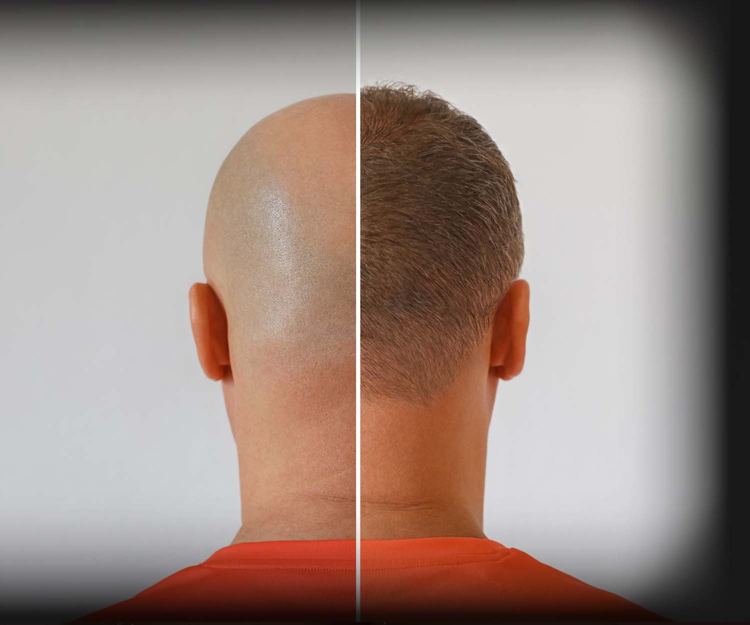Vikramjeet Singh Dhingra - Hair Transplant Surgeon at Best Plastic Surgery India