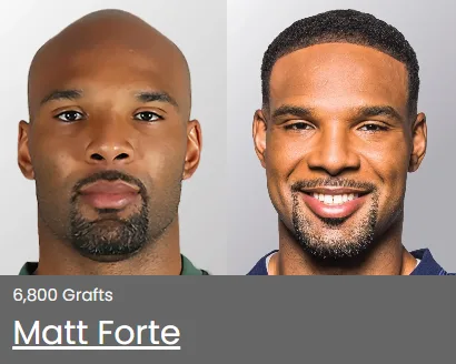 Before and after hair transplant result at Restore Hair