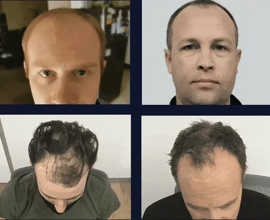 Before and after hair transplant result at Aesthetica Hair Restoration