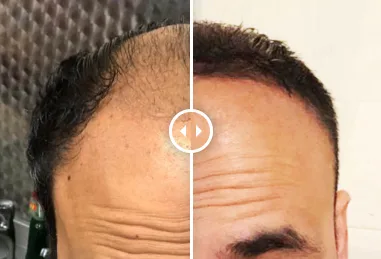 Before and after hair transplant result at One Medical Hair Transplant Clinic