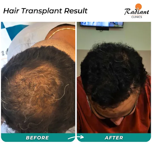 Before and after hair transplant result at Radiant Aesthetics Clinic