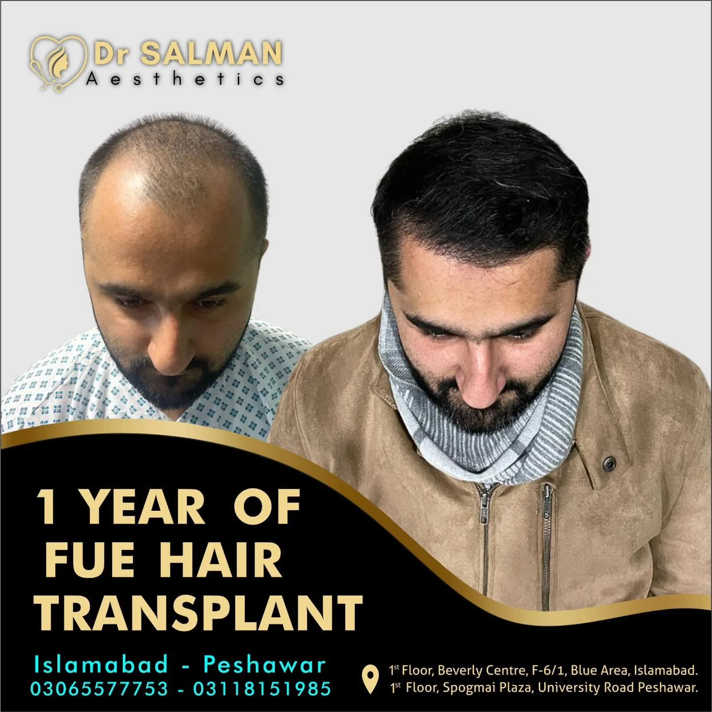 Before and after hair transplant result at Dr. Salman Aesthetics