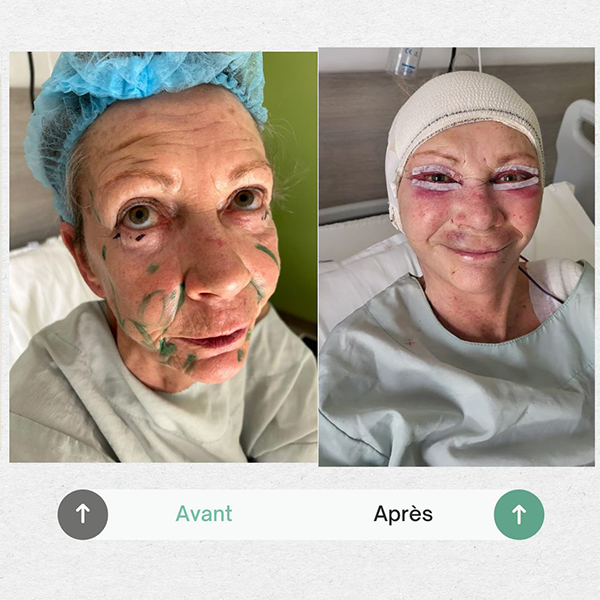 Before and after hair transplant result at Medikalista