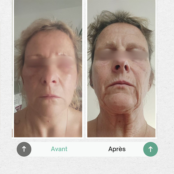 Before and after hair transplant result at Medikalista
