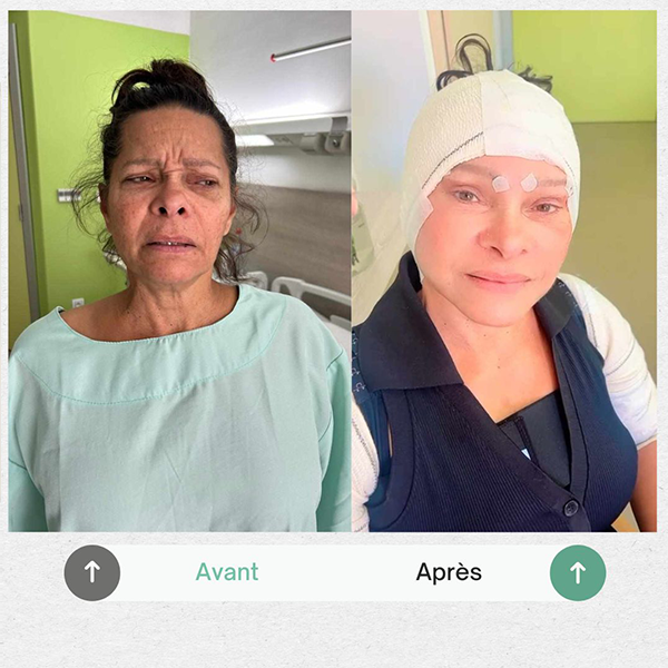 Before and after hair transplant result at Medikalista