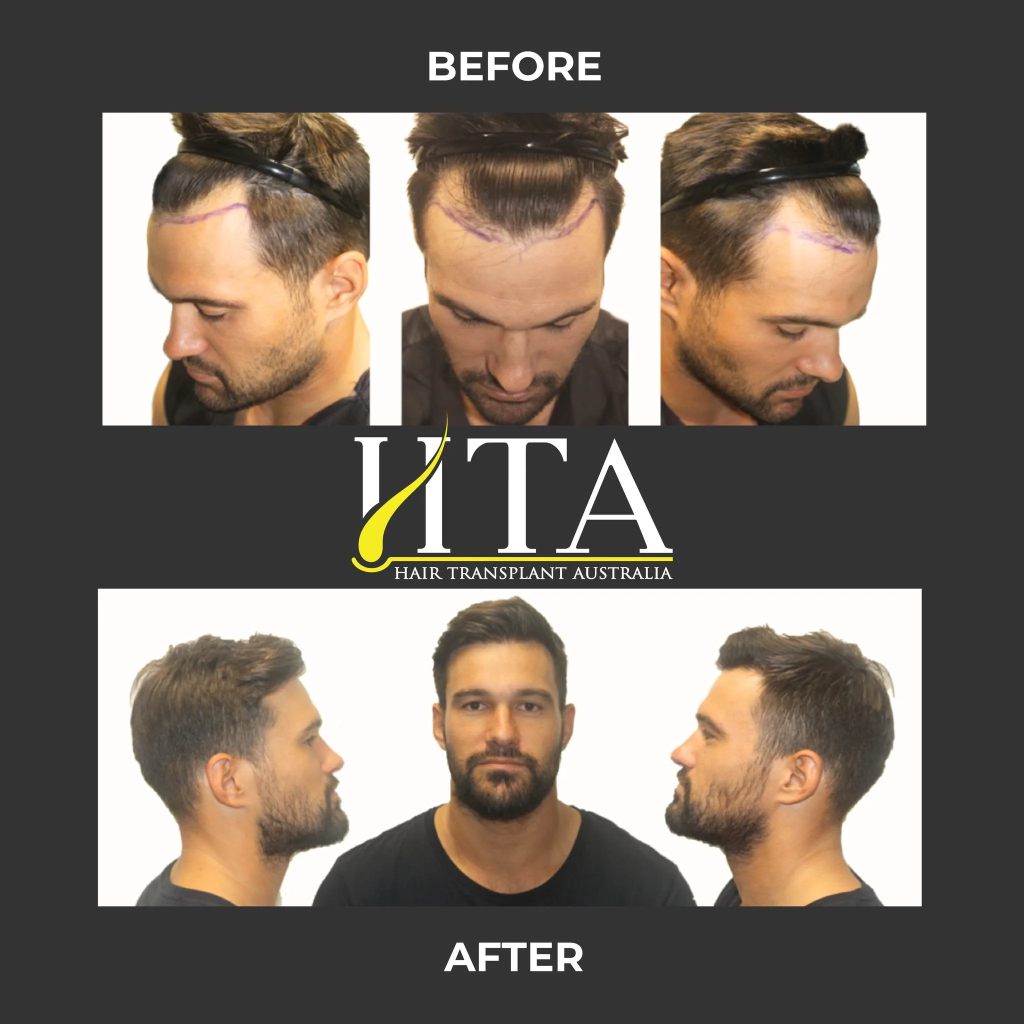 Before and after hair transplant result at Hair Transplant