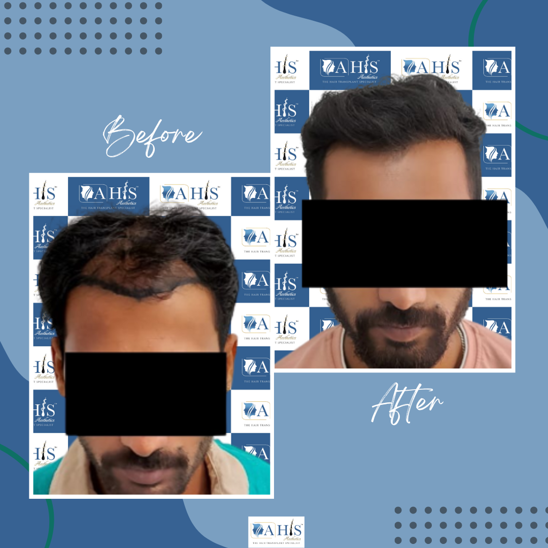 AHIS Aesthetics - The Hair Transplant Specialist