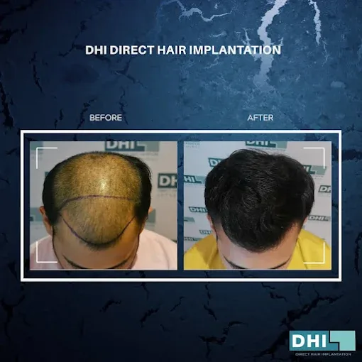 Before and after hair transplant result at DHI Hair Restoration Clinic
