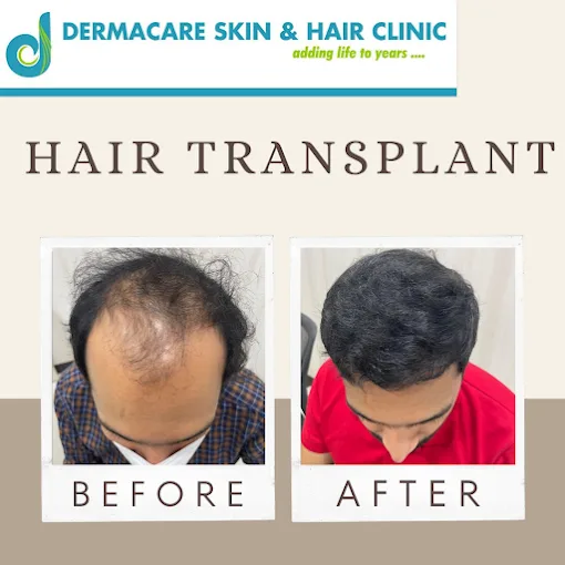 Before and after hair transplant result at Dermacare Hair Clinic