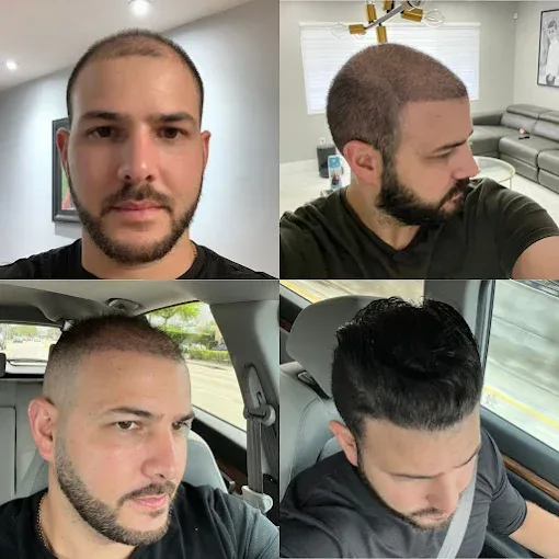 Before and after hair transplant result at Hair Transplant Design