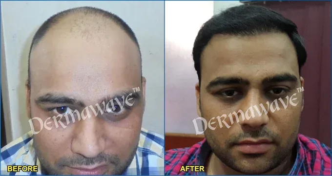 Before and after hair transplant result at Dermawave