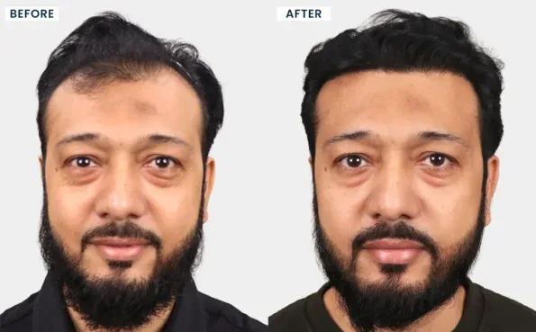 Before and after hair transplant result at HairFree & HairGrow Clinic