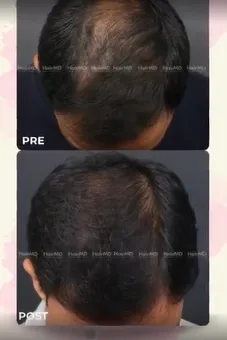 Before and after hair transplant result at Clear Skin & HairMD