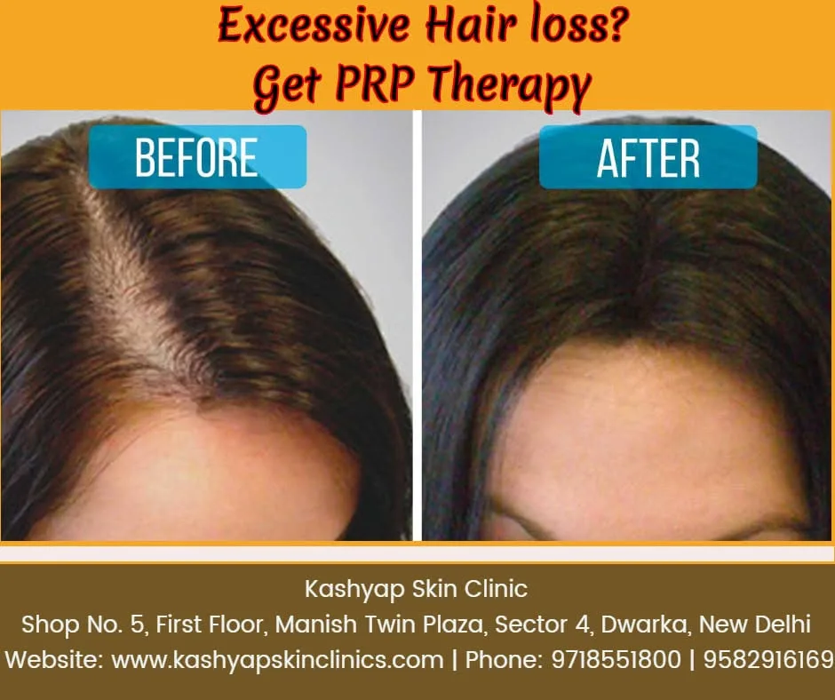Before and after hair transplant result at Kashyap Skin Clinics