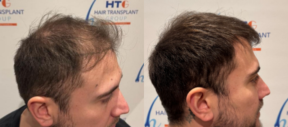 HTG Hair Transplant Group London clinic