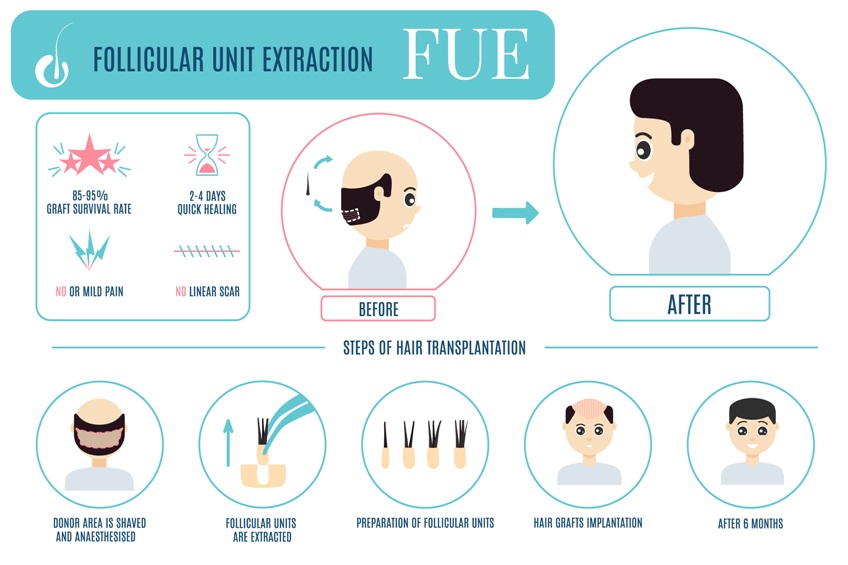 Before and after hair transplant result at FUE Hair Restoration